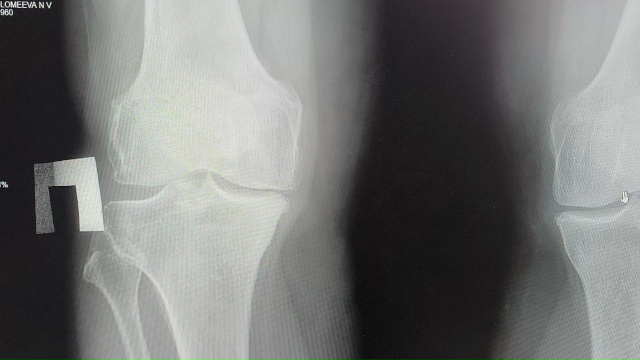 За первую новогоднюю неделю в травмцентре БСМП Рязани оказали помощь 139 гражданам с переломами