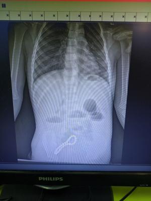 Рязанские хирурги спасли малыша, проглотившего магнитный браслет